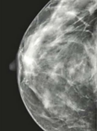 Mammogram. Breast health naturally herbs functional nutition.